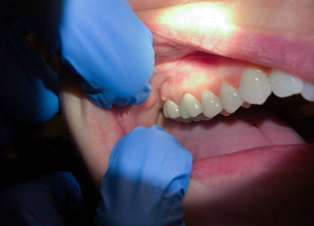 Best Emergency Cosmetic Dentistry (e.g., broken veneers) in Redwood Valley, CA